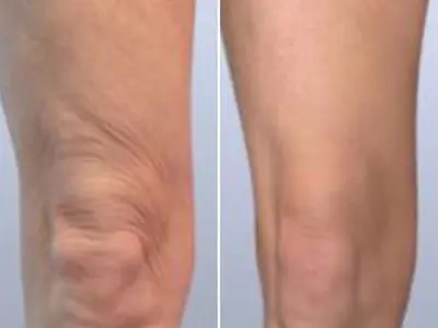 skin tightening